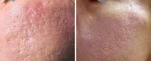 Acne Scars Treatment Acne Scars Treatment