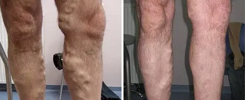 Endovenöse Laserbehandlung Endovenöse Laserbehandlung