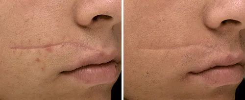 Gesichtsnarben-Behandlung Gesichtsnarben-Behandlung